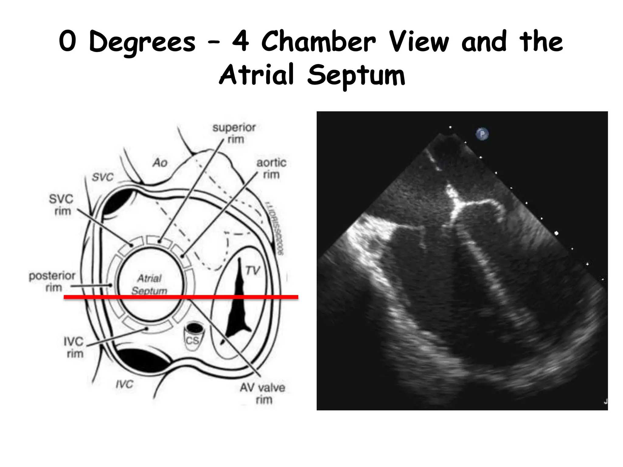 0 Degrees – 4 Chamber View and the
Atrial Septum
 