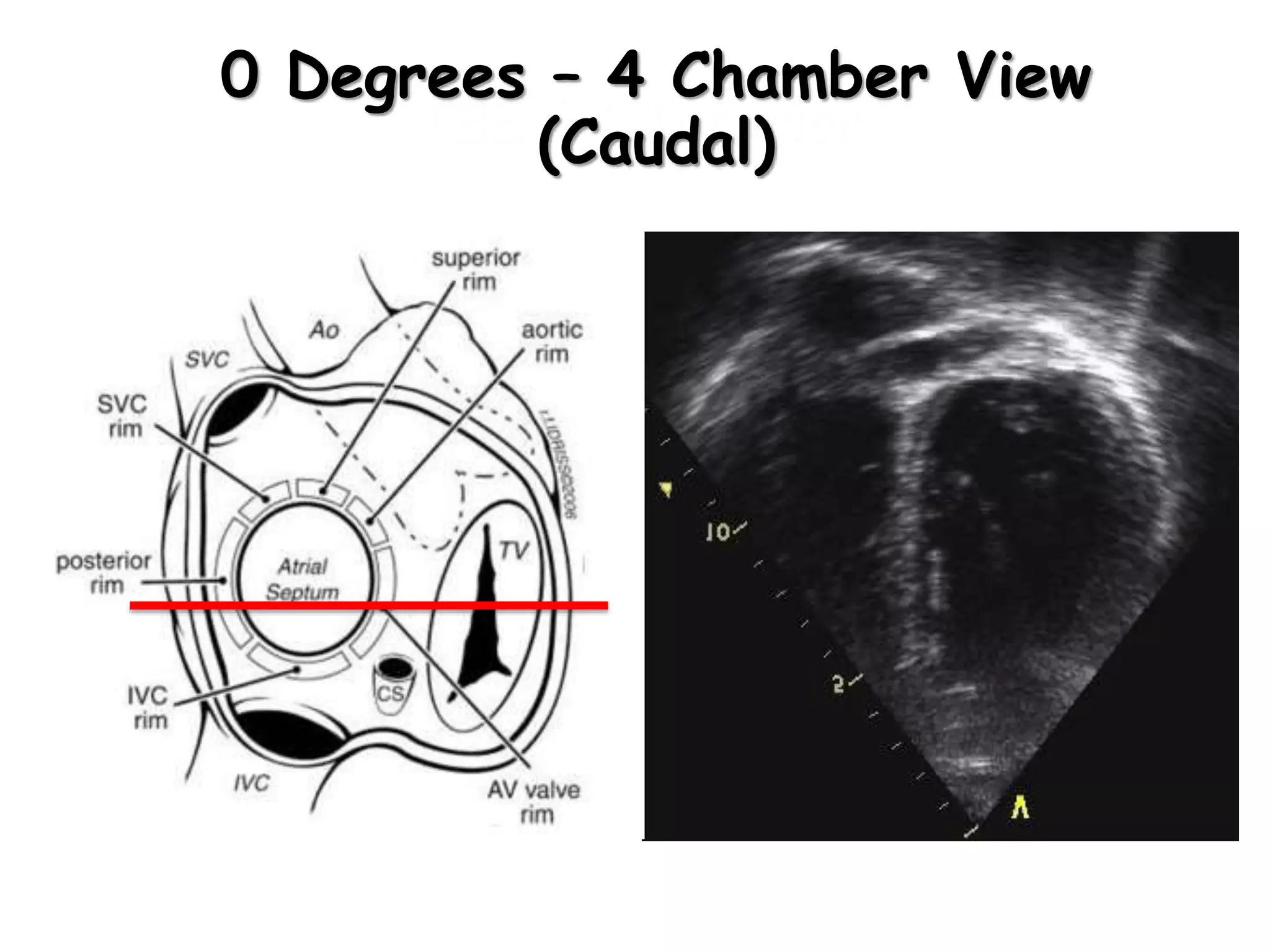 TEE 0º Inferior
0 Degrees – 4 Chamber View
(Caudal)
 
