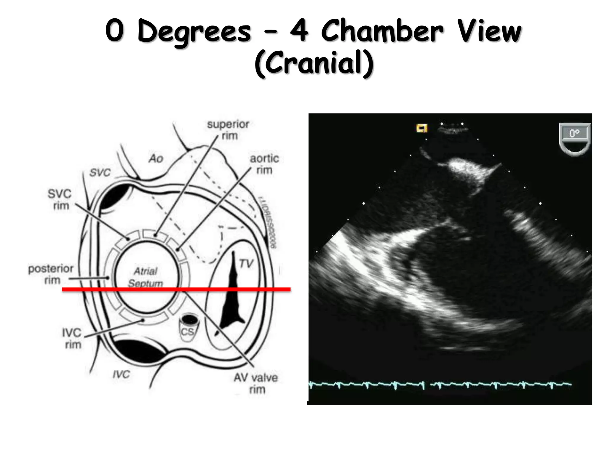 0 Degrees – 4 Chamber View
(Cranial)
 
