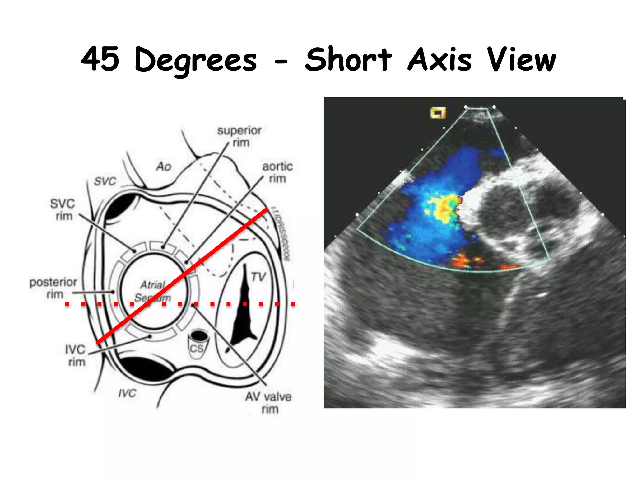 T0º
45 Degrees - Short Axis View
 