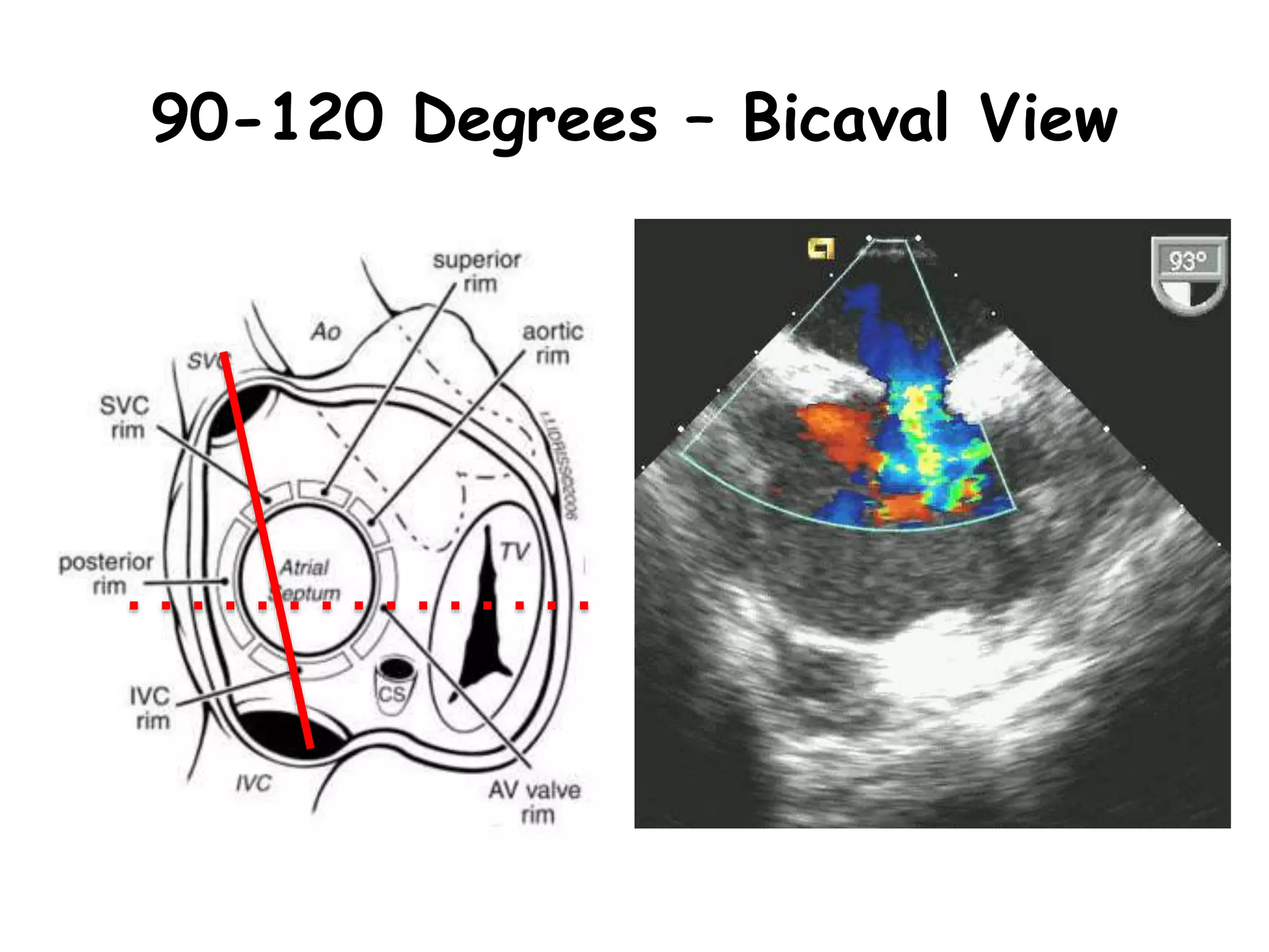 90-120 Degrees – Bicaval View
 