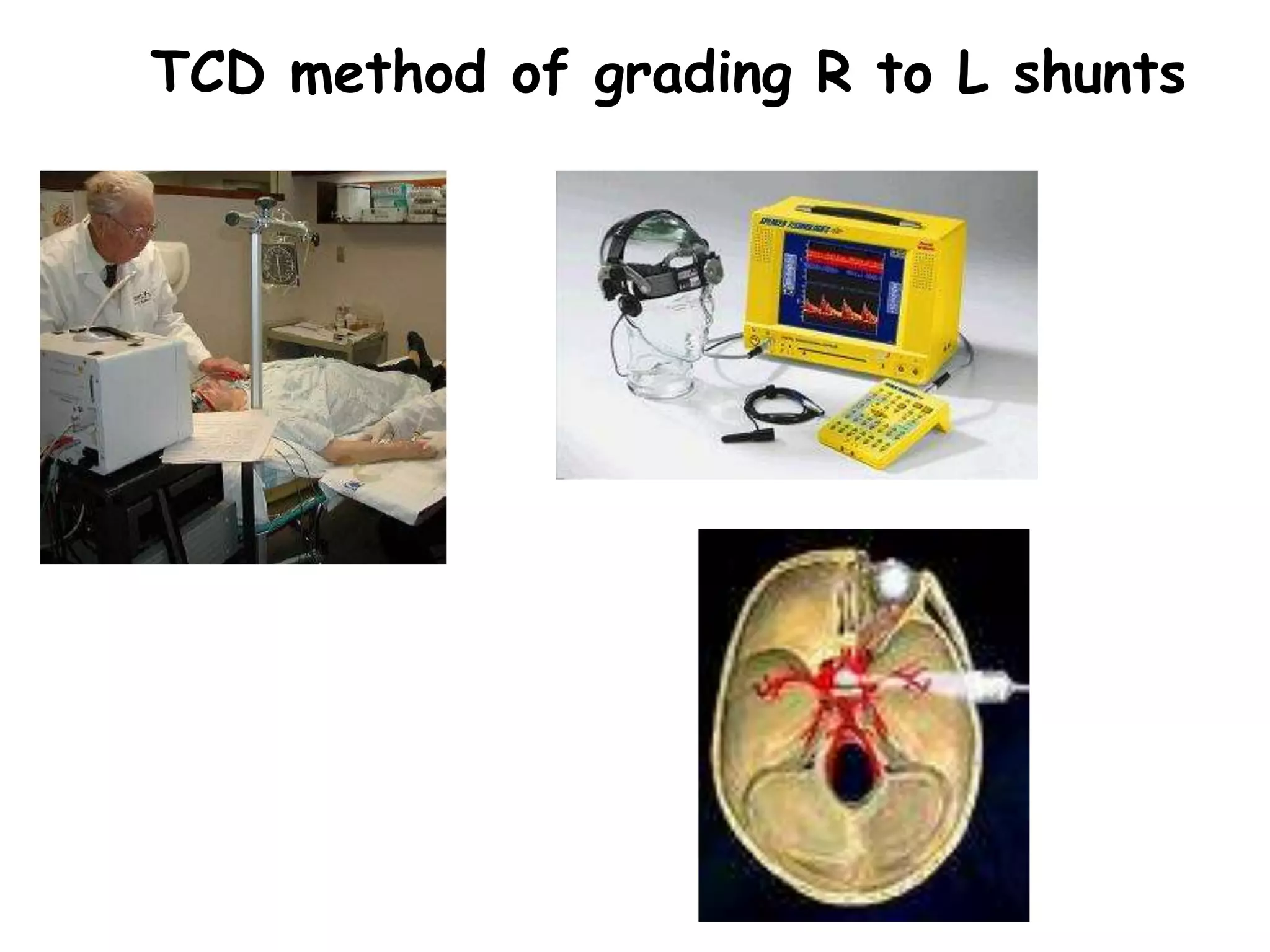 TCD method of grading R to L shunts
 