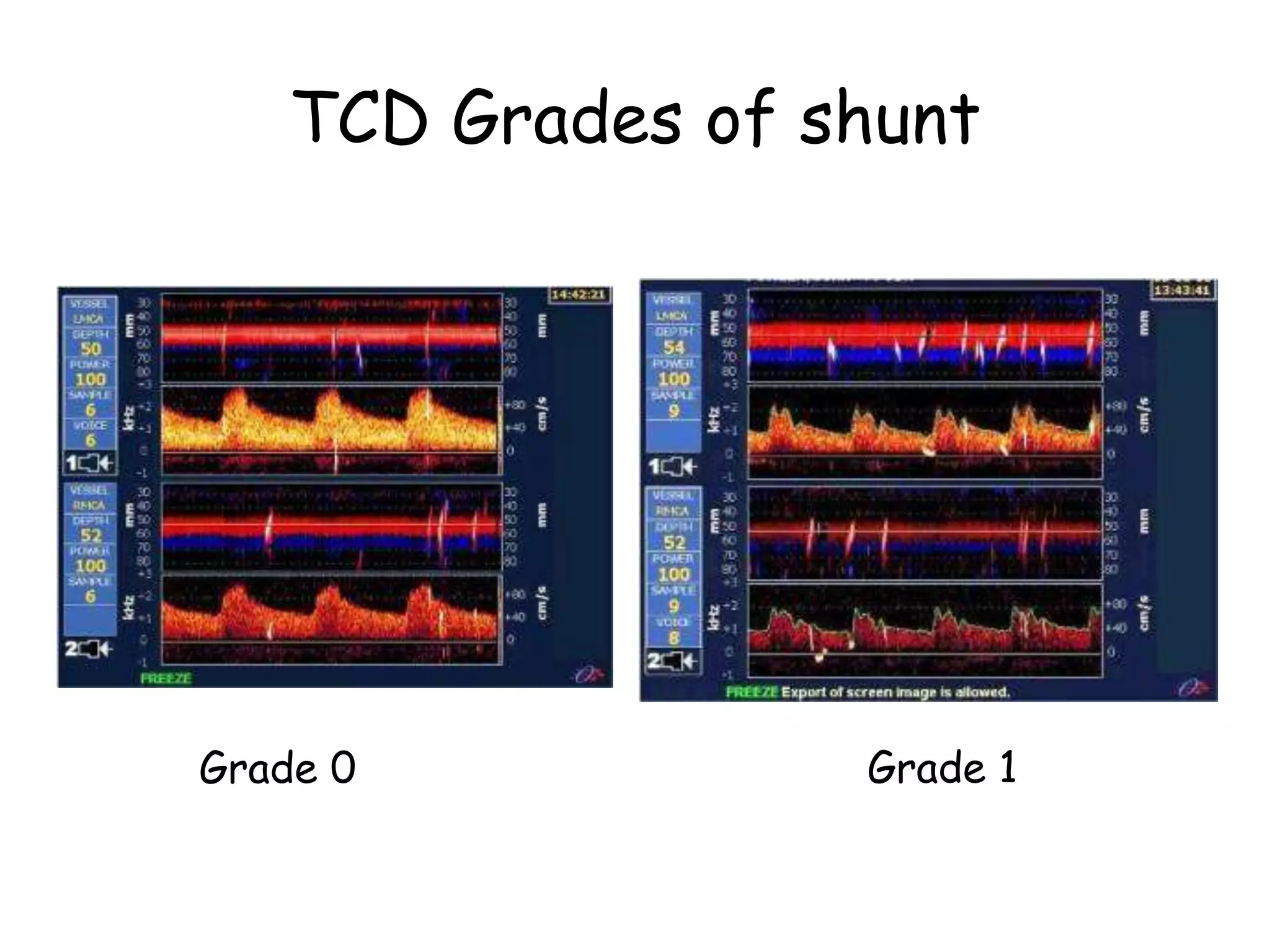 TCD Grades of shunt
Grade 0 Grade 1
 