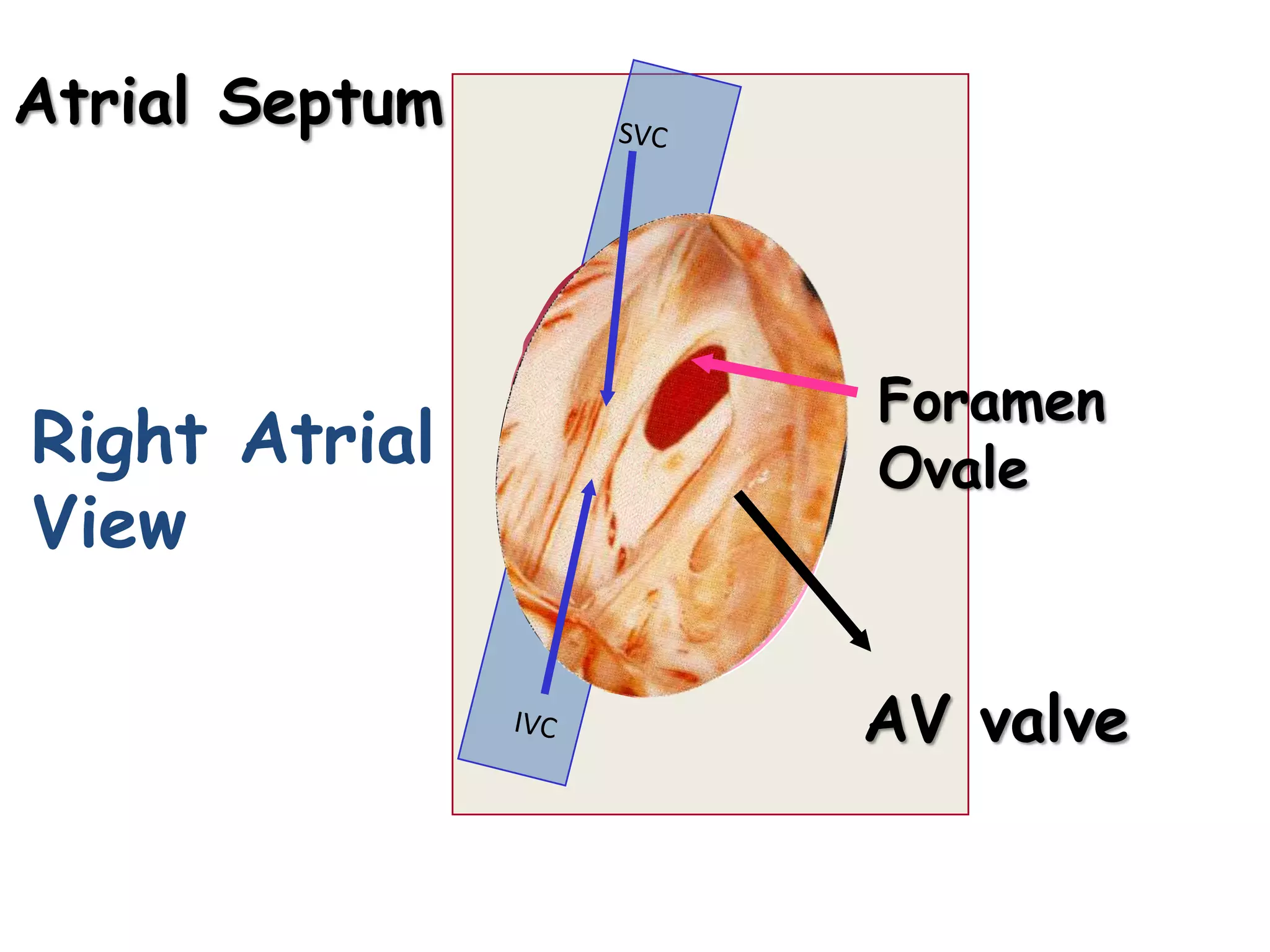 Atrial Septum
AV valve
Foramen
Ovale
Right Atrial
View
 