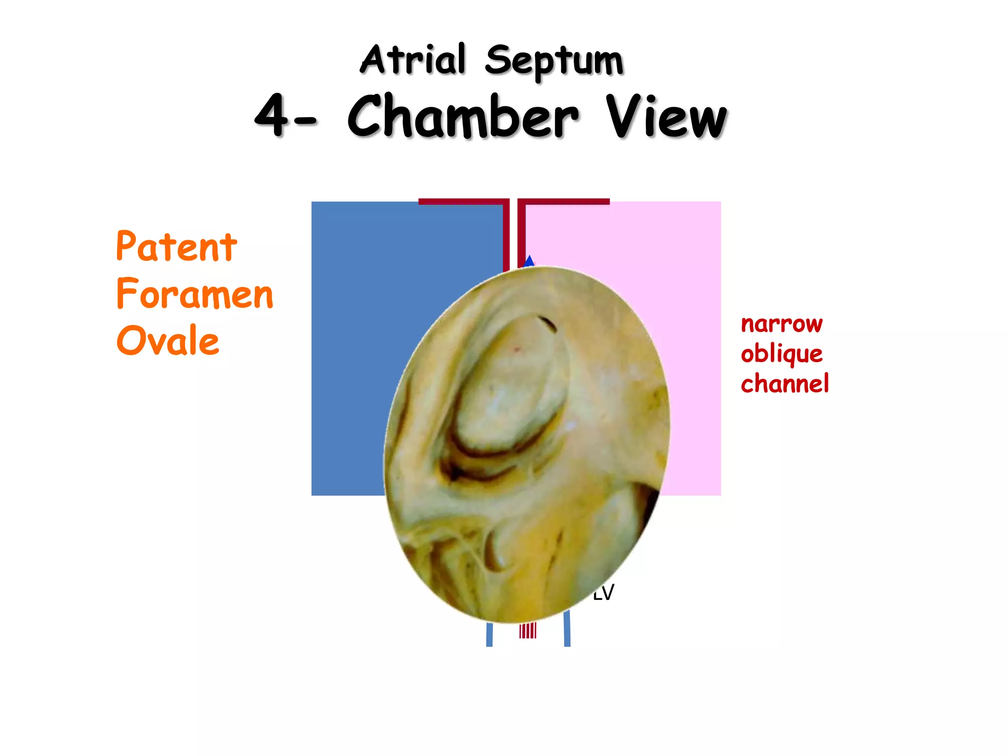 Atrial Septum
4- Chamber View
Patent
Foramen
Ovale
RA LA
RV LV
narrow
oblique
channel
 