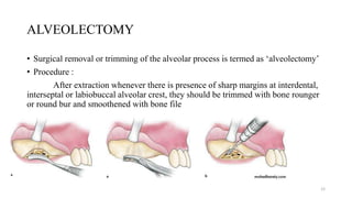 ALVEOLECTOMY
• Surgical removal or trimming of the alveolar process is termed as ‘alveolectomy’
• Procedure :
After extraction whenever there is presence of sharp margins at interdental,
interseptal or labiobuccal alveolar crest, they should be trimmed with bone rounger
or round bur and smoothened with bone file
12
 