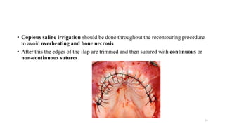 • Copious saline irrigation should be done throughout the recontouring procedure
to avoid overheating and bone necrosis
• After this the edges of the flap are trimmed and then sutured with continuous or
non-continuous sutures
15
 