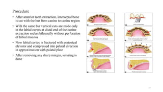 Procedure
• After anterior teeth extraction, interseptal bone
is cut with the bur from canine to canine region
• With the same bur vertical cuts are made only
in the labial cortex at distal end of the canine
extraction socket bilaterally without perforation
of labial mucosa
• Now labial cortex is fractured with periosteal
elevator and compressed into palatal direction
in approximation with palatal plate
• After removing any sharp margin, suturing is
done
17
 