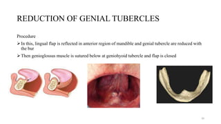 REDUCTION OF GENIAL TUBERCLES
Procedure
In this, lingual flap is reflected in anterior region of mandible and genial tubercle are reduced with
the bur
Then genioglossus muscle is sutured below at geniohyoid tubercle and flap is closed
20
 