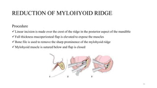 REDUCTION OF MYLOHYOID RIDGE
Procedure
Linear incision is made over the crest of the ridge in the posterior aspect of the mandible
Full thickness mucoperiosteal flap is elevated to expose the muscles
Bone file is used to remove the sharp prominence of the mylohyoid ridge
Mylohyoid muscle is sutured below and flap is closed
21
 