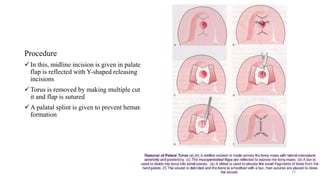 Procedure
In this, midline incision is given in palate and
flap is reflected with Y-shaped releasing
incisions
Torus is removed by making multiple cuts of
it and flap is sutured
A palatal splint is given to prevent hematoma
formation
23
 