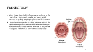 FRENECTOMY
• Many times, there is high frenum attached near to the
crest of the ridge which may be too broad which
interfere in getting proper peripheral seal in dentures
• Lingual frenum may be too short and attached till the
tip of the tongue which interfere with normal tongue
movements and causes speech problem to the patient,
so surgical correction is advocated in these cases
30
 