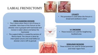 LABIAL FRENECTOMY
CROSS-DIAMOND EXCISION
• This is done when there is lot of tissue is
available. Here base of the frenum at the
alveolar crest is grasped with haemostat and
incision is taken above and below the
haemostat
• The surgical defect is created by excision of
fibrous band. The closure is done by
interrupted sutures and small defect at
alveolar crest is left to granule
SEMILUNAR INCISIONS
• These incisions are used for broad premolar
and molar region freni
Z-PLASTY
• This procedure is used when the frenum is
broad and vestibule is short
V-Y INCISIONS
• These incisions are used for lengthening
localized area
31
 