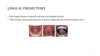 LINGUAL FRENECTOMY
• Here lingual frenum is reduced by giving cross-diamond incision
• After incision, sub-mucosal dissection is done on either side and vertical suturing is given
32
 