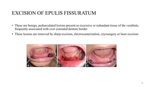 EXCISION OF EPULIS FISSURATUM
• These are benign, pedunculated lesions present as excessive or redundant tissue of the vestibule,
frequently associated with over extended denture border
• These lesions are removed by sharp excision, electrocauterization, cryosurgery or laser excision
33
 