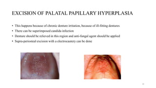 EXCISION OF PALATAL PAPILLARY HYPERPLASIA
• This happens because of chronic denture irritation, because of ill-fitting dentures
• There can be superimposed candida infection
• Denture should be relieved in this region and anti-fungal agent should be applied
• Supra-periosteal excision with a electrocautery can be done
34
 