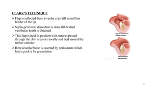 CLARK’S TECHNIQUE
Flap is reflected from alveolar crest till vermillion
border of the lip
Supra-periosteal dissection is done till desired
vestibular depth is obtained
This flap is held in position with sutures passed
through the chin area extraorally and tied around the
rubber catheter
Here alveolar bone is covered by periosteum which
heals quickly by granulation
40
 