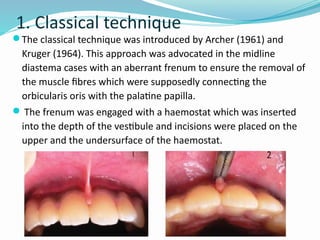 Pre-Prosthetic Surgery (3)oral and maxillofacial perspective.pptx