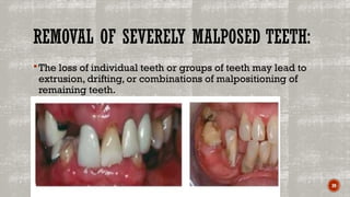 PRE-PROSTHETIC SURGERY FOR REMOVABLE PARTIAL DENTURE | PPTX