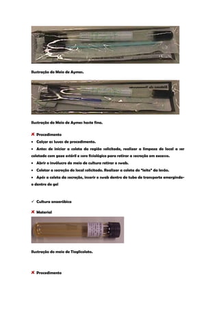 Ilustração do Meio de Aymes. 
Ilustração do Meio de Aymes haste fina. Procedimento Calçar as luvas de procedimento. Antes de iniciar a coleta da região solicitada, realizar a limpeza do local a ser coletado com gaze estéril e soro fisiológico para retirar a secreção em excesso. Abrir o invólucro do meio de cultura retirar o swab. Coletar a secreção do local solicitado. Realizar a coleta do “leito” da lesão. Após a coleta da secreção, inserir o swab dentro do tubo de transporte emergindo- o dentro do gel 
 Cultura anaeróbica Material 
Ilustração do meio de Tioglicolato. 
Procedimento  