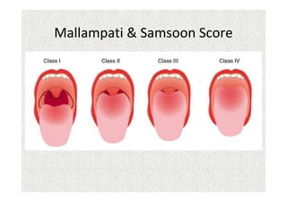 Mallampati & Samsoon Score
 