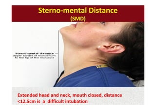 Sterno-mental Distance
(SMD)
Extended head and neck, mouth closed, distance
<12.5cm is a difficult intubation
 