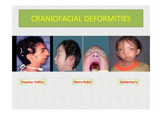 CRANIOFACIAL DEFORMITIES
Pierre Robin Goldenhar'sTreacher Collins
 