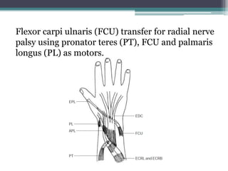Flexor carpi ulnaris (FCU) transfer for radial nerve
palsy using pronator teres (PT), FCU and palmaris
longus (PL) as motors.
 