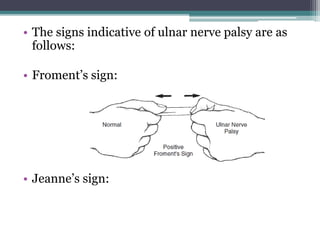 • The signs indicative of ulnar nerve palsy are as
follows:
• Froment’s sign:
• Jeanne’s sign:
 