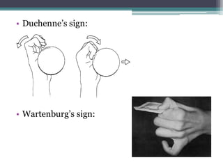 • Duchenne’s sign:
• Wartenburg’s sign:
 