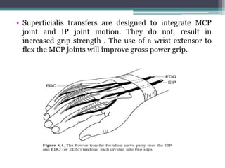 • Superficialis transfers are designed to integrate MCP
joint and IP joint motion. They do not, result in
increased grip strength . The use of a wrist extensor to
flex the MCP joints will improve gross power grip.
 