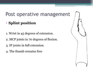 Post operative management
• Splint position
1. Wrist in 45 degrees of extension.
2. MCP joints in 70 degrees of flexion.
3. IP joints in full extension.
4. The thumb remains free
 