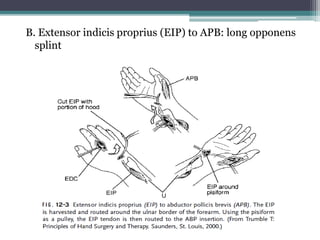 B. Extensor indicis proprius (EIP) to APB: long opponens
splint
 