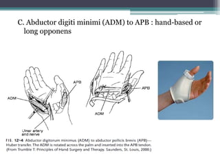 C. Abductor digiti minimi (ADM) to APB : hand-based or
long opponens
 