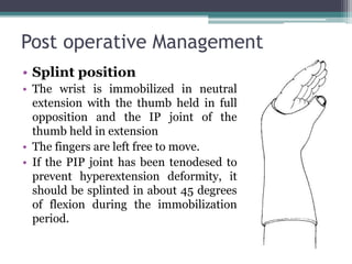 Post operative Management
• Splint position
• The wrist is immobilized in neutral
extension with the thumb held in full
opposition and the IP joint of the
thumb held in extension
• The fingers are left free to move.
• If the PIP joint has been tenodesed to
prevent hyperextension deformity, it
should be splinted in about 45 degrees
of flexion during the immobilization
period.
 