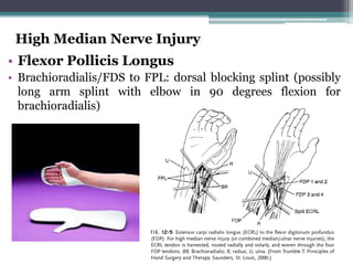 High Median Nerve Injury
• Flexor Pollicis Longus
• Brachioradialis/FDS to FPL: dorsal blocking splint (possibly
long arm splint with elbow in 90 degrees flexion for
brachioradialis)
 