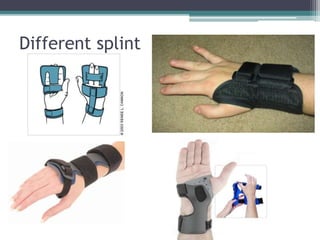Different splint
 