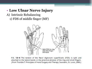 • Low Ulnar Nerve Injury
A) Intrinsic Rebalancing
1) FDS of middle finger (MF)
 