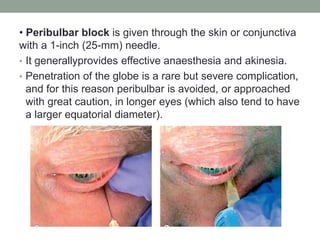 • Peribulbar block is given through the skin or conjunctiva
with a 1-inch (25-mm) needle.
• It generallyprovides effective anaesthesia and akinesia.
• Penetration of the globe is a rare but severe complication,
and for this reason peribulbar is avoided, or approached
with great caution, in longer eyes (which also tend to have
a larger equatorial diameter).
 