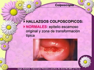 Organismos (Cándida, Trichomona, Gardnerella, Actinomyces, Herpes) 10%Cambios reactivos ó reparativos 90%Atrofia celular  é  inflamación NegativoParaLIE (BCC)ASCUSCélulas escamosas atípicas (ASC)ASC-HLesión intrapitelialde bajo grado (LSIL)VHP NIC IEscamosaLesión intrapitelialde alto grado (HSIL)NIC II, III  in situCa de cel escamosasEscamocelularEndocervicalEndometrialFavorece neoplasiaCélulas glandulares Atípicas (AGC)GlandularAdenoca in situ (AIS)AdenocarcinomaSISTEMA DE BETHESDA:  Interpretación de resultadosDeficiencia E2, Qx, Radioterapia, coito, tampones, DIUCrecimiento nuclear y celular, vacuolización citoplasmática, multinucleación; inflamación, hiperplasia, proliferación papilar epitelio endo-cervical, incremento de metaplasia escamosaAnormalidad de célula epitelialWright TC, Moscarelli RD, Dole P, Ellerbrock TV, Chiasson MA, Vandevanter N.  Clinicalsignificance of mildcytologicatypiaon Papanicolaou smearsfromwomeninfectedwithhumanimmunodeficiency virus. ObstetGynecol. 1996;87:515-519. 