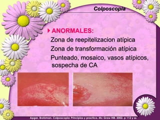 ScreeningColposcopiaEn  mas del 78% de los ASCUS el resultadocolposcopicoes normalEl riesgo de cancer aumenta la ansiedad de los pacientes.ProcedimientoinvasivoLa mayor  proporciónde  HSIL proviene de mujeresquetienenreportes de citologíacon ASCUS Apgar, Brotzman. Colposcopia: Principios y practica. Mc Graw Hill. 2002. p 112 y ss