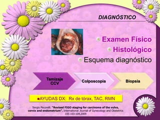 Incidencia mundial del Ca en mujeresA nivel mundial la menor tasa de Ca de Cervix se encuentra en Israel.International agencyforresearchonCancer