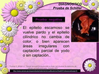 EPIDEMIOLOGÍA> 80% con Dx de cáncer cervicouterino viven en países en desarrolloEnfermedad en un estadio avanzado.Primera causa de muerte por cáncer maligno en mujeres de 25 a 64 años de edad.Wright TC, Massad LS, Dunton CJ, et al. 2006 Consensus guidelines for the management of women with abnormal cervical cancer screening tests. Am J ObstetGynecol 2007;197:346–55