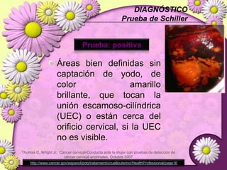 ETIOLOGÍA>99% HPV 16HPV 18