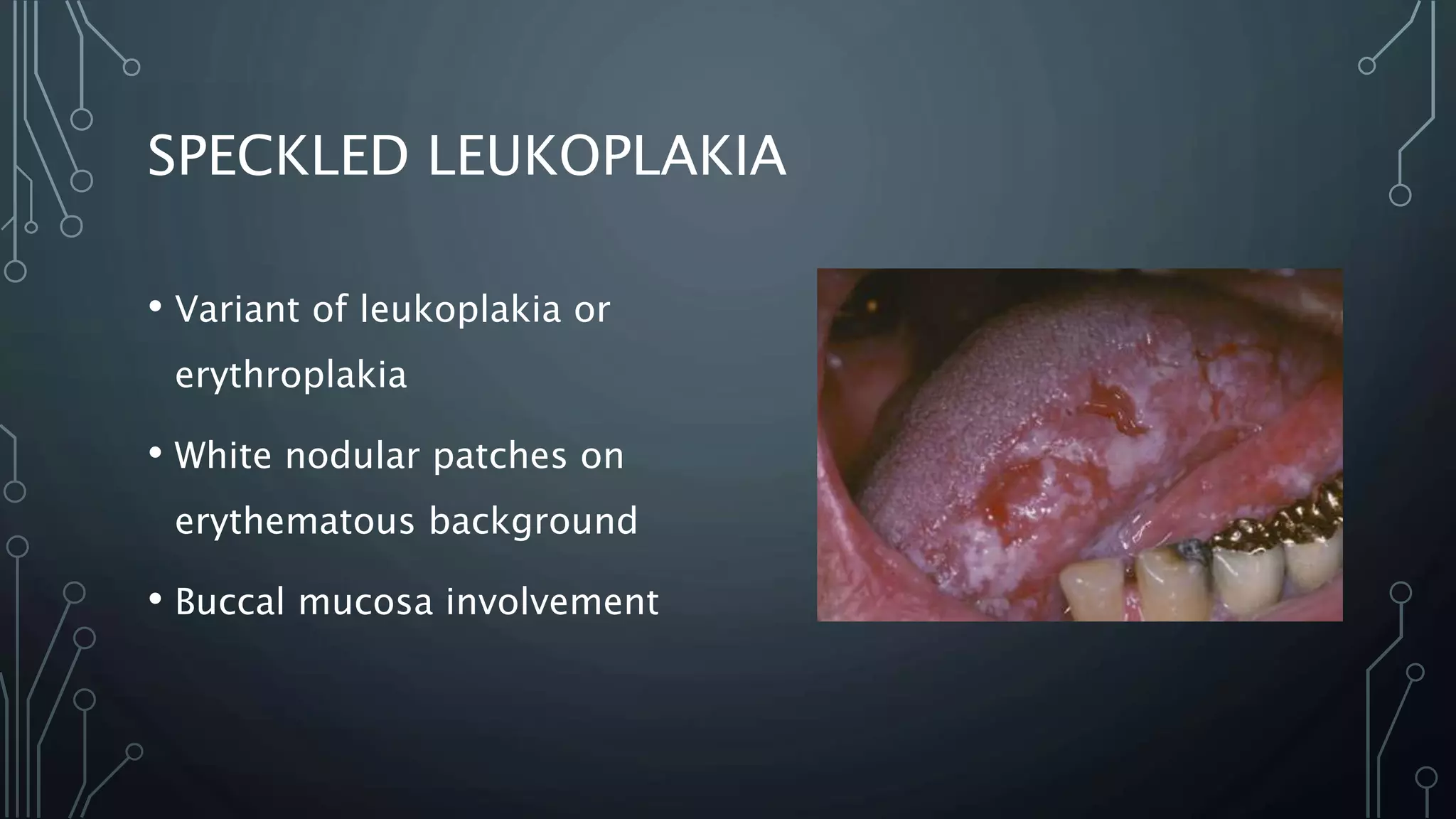 SPECKLED LEUKOPLAKIA
• Variant of leukoplakia or
erythroplakia
• White nodular patches on
erythematous background
• Buccal mucosa involvement
 