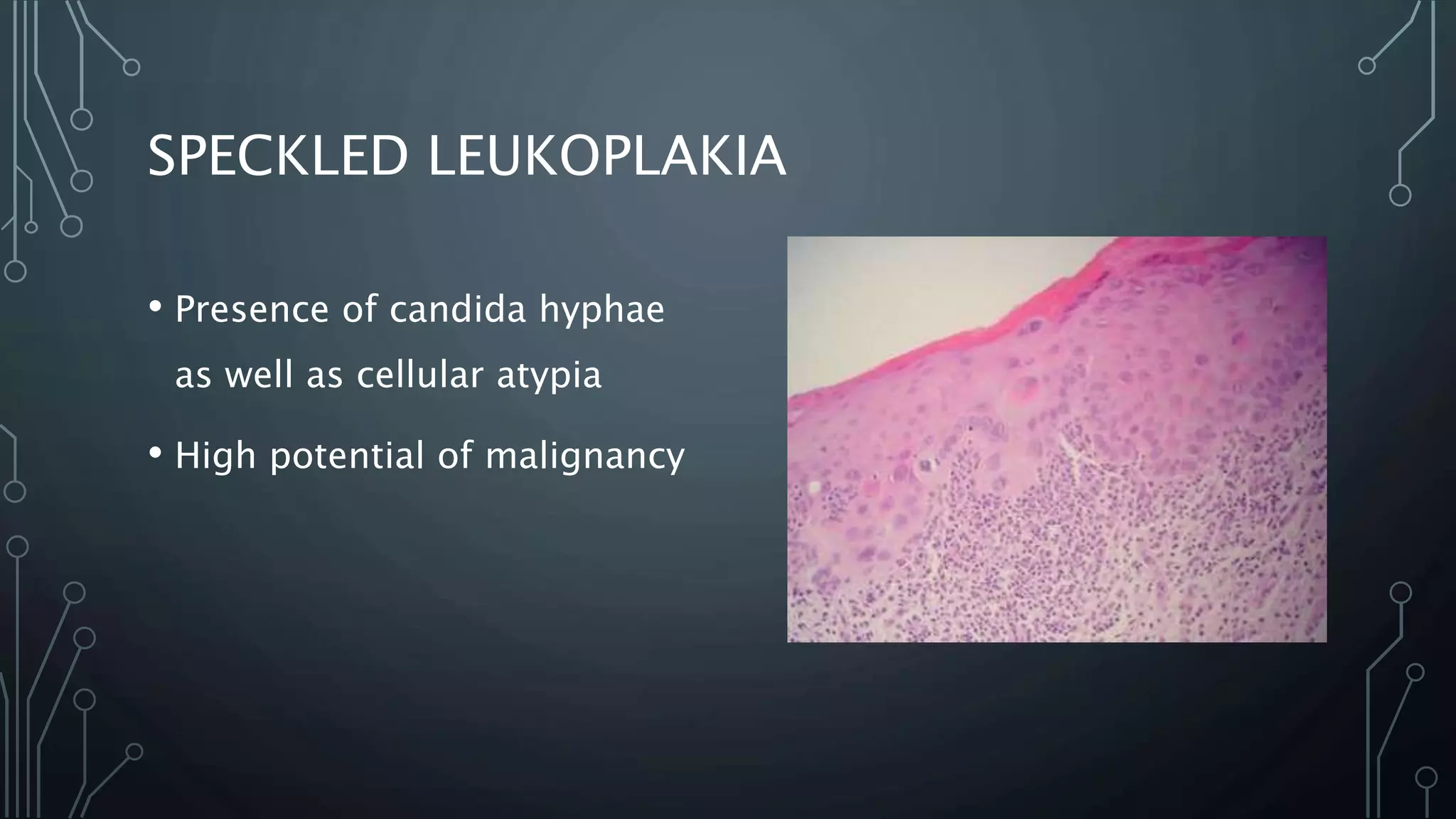 SPECKLED LEUKOPLAKIA
• Presence of candida hyphae
as well as cellular atypia
• High potential of malignancy
 