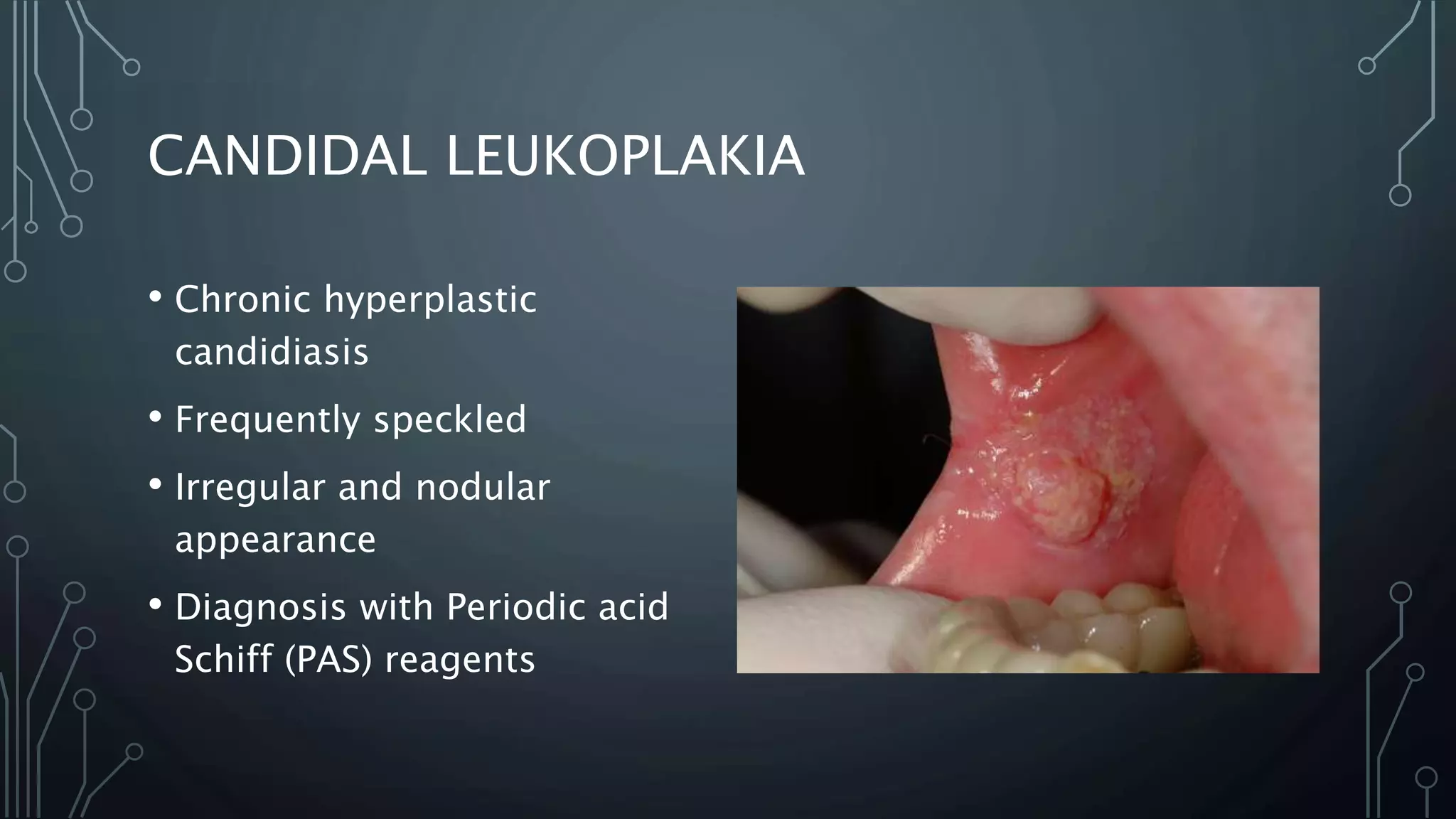 CANDIDAL LEUKOPLAKIA
• Chronic hyperplastic
candidiasis
• Frequently speckled
• Irregular and nodular
appearance
• Diagnosis with Periodic acid
Schiff (PAS) reagents
 