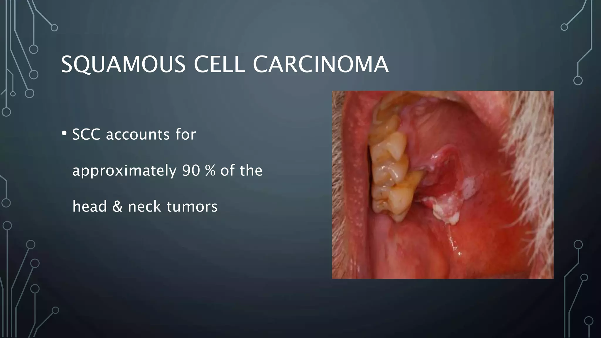 SQUAMOUS CELL CARCINOMA
• SCC accounts for
approximately 90 % of the
head & neck tumors
 