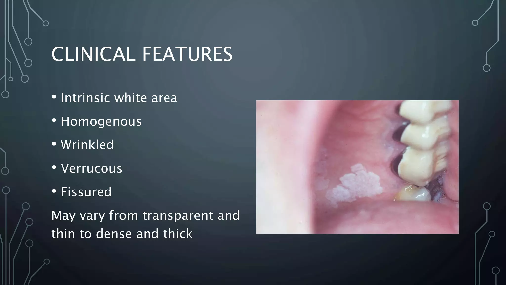 CLINICAL FEATURES
• Intrinsic white area
• Homogenous
• Wrinkled
• Verrucous
• Fissured
May vary from transparent and
thin to dense and thick
 