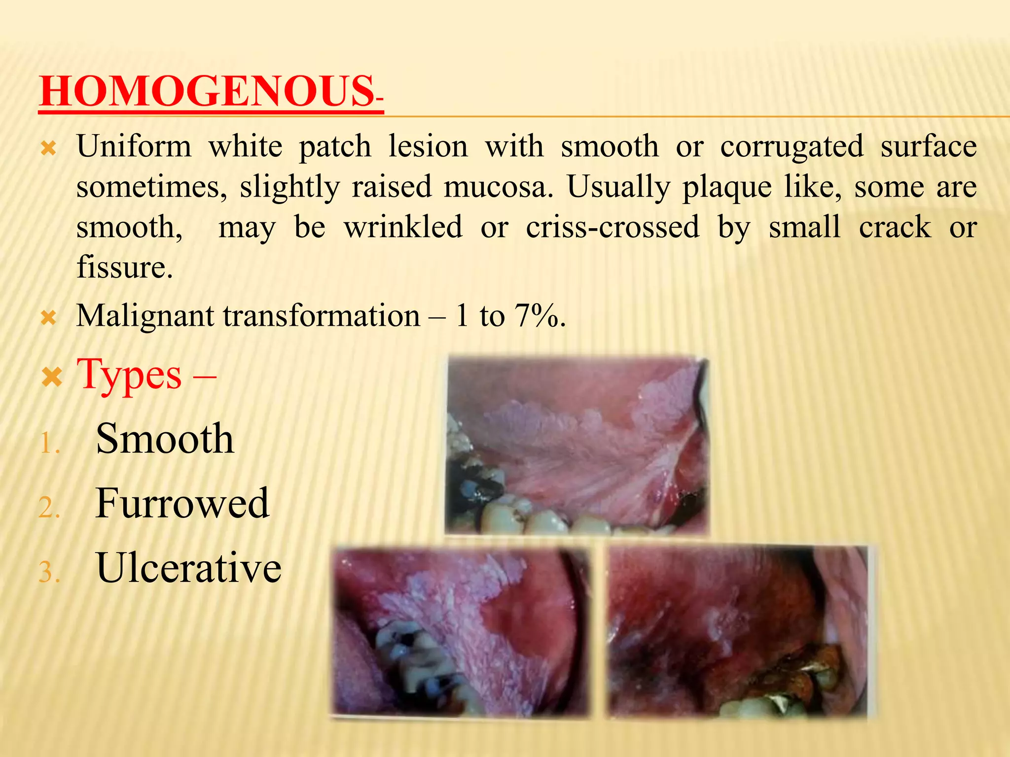 HOMOGENOUS-
 Uniform white patch lesion with smooth or corrugated surface
sometimes, slightly raised mucosa. Usually plaque like, some are
smooth, may be wrinkled or criss-crossed by small crack or
fissure.
 Malignant transformation – 1 to 7%.
 Types –
1. Smooth
2. Furrowed
3. Ulcerative
 
